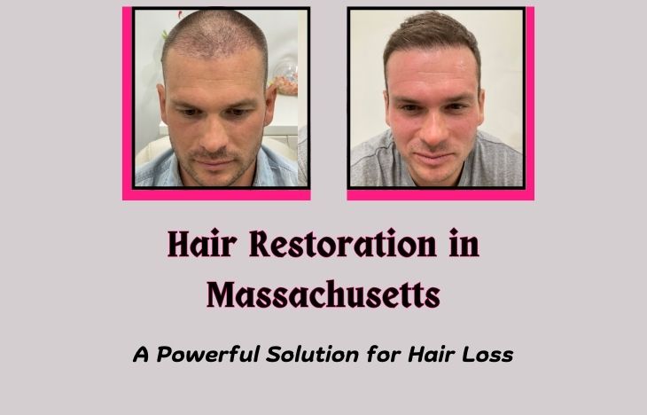 Hair-Restoration-in-Massachusetts-A-Powerful-Solution-for-Hair-Loss