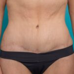 Tummy tuck NYC