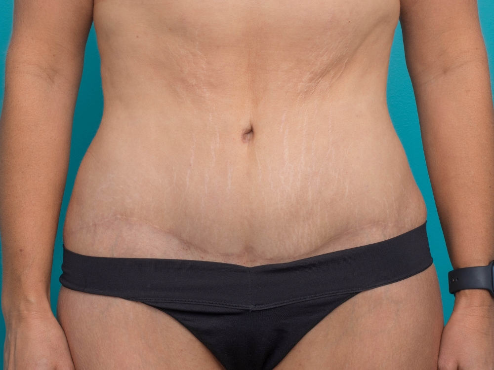 Tummy tuck NYC