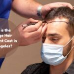 hair transplant cost los angeles