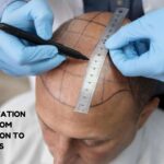 hair transplantation clinic
