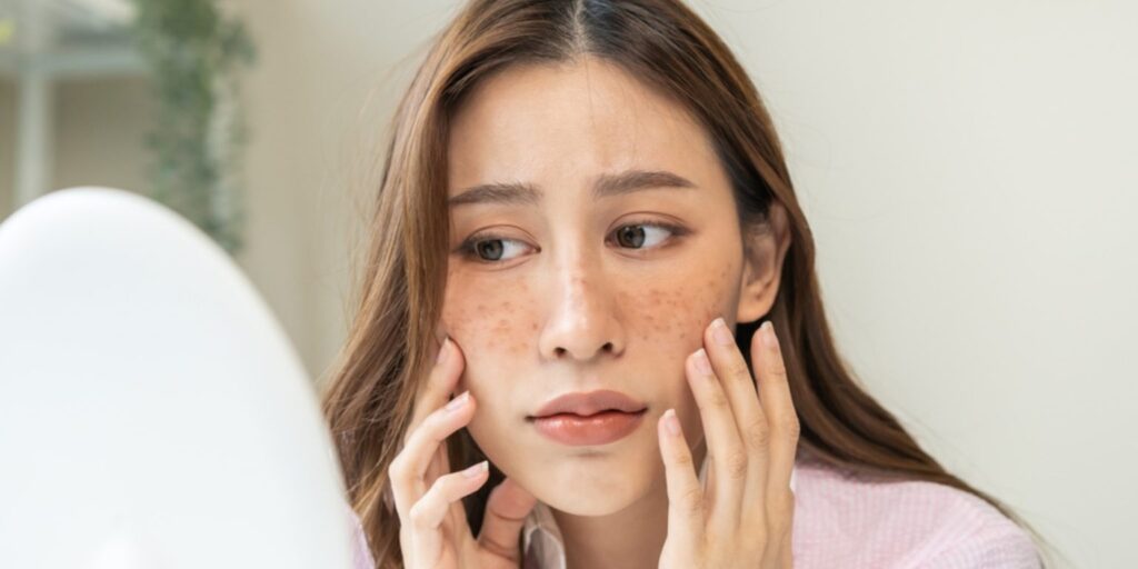 melasma prevention, summer skincare, skin pigmentation