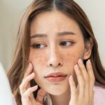 melasma prevention, summer skincare, skin pigmentation