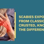 scrabies