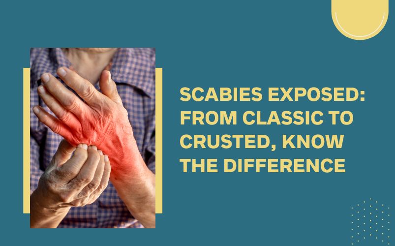 scrabies