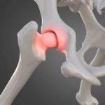 Best Hip Replacement Surgeon in Jaipur