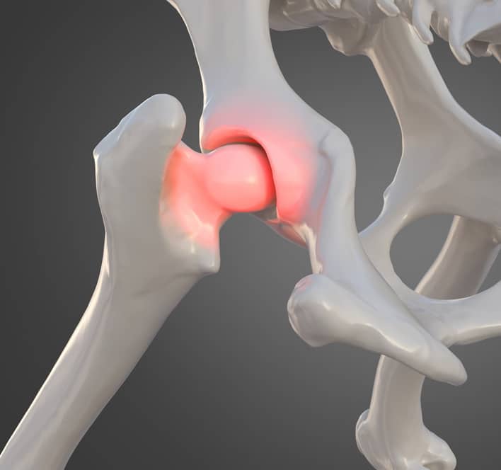 Best Hip Replacement Surgeon in Jaipur