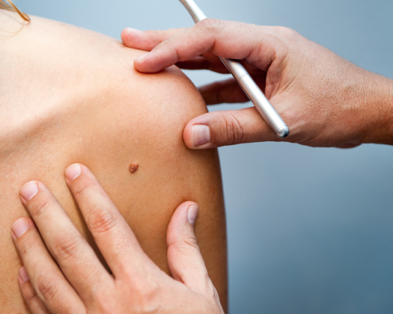 how much is wart laser removal