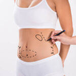 Liposuction surgery in Dubai