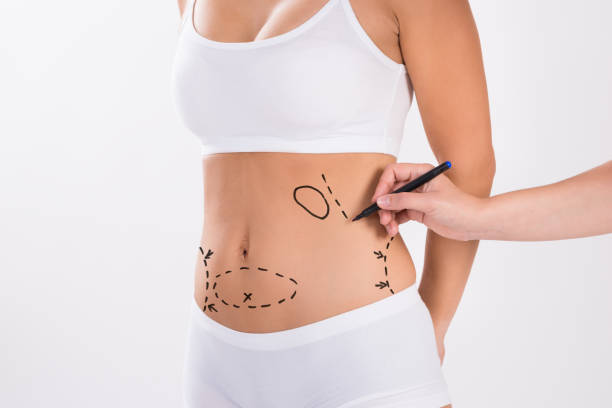 Liposuction surgery in Dubai