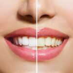 Dental Cleanings