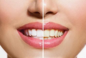 Dental Cleanings