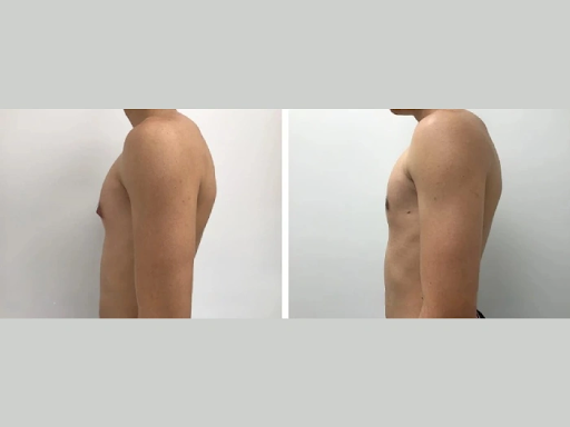 Gynecomastia in Dubai Teens: What Parents Need to Know
